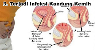 Terjadi Infeksi Kandung Kemih akibat sering Menahan buang air kecil