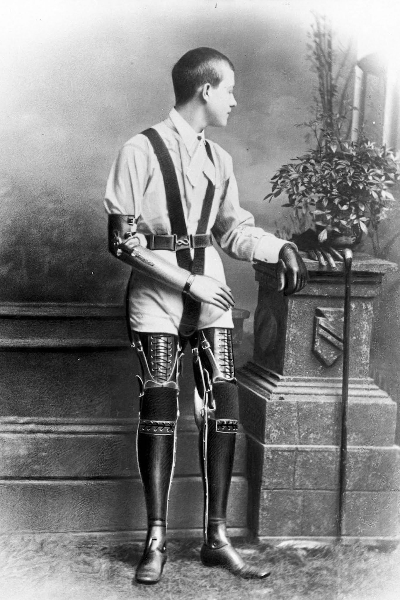 The extraordinary early prostheses made by James Gillingham  1900 - 2