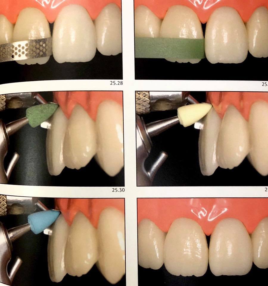 Adhesive cementation " emax cementation protocol “ Dental Esthetics