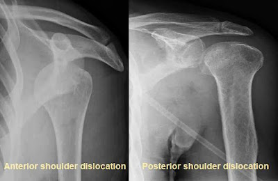 Anterior and posterior shoulder dislocation.