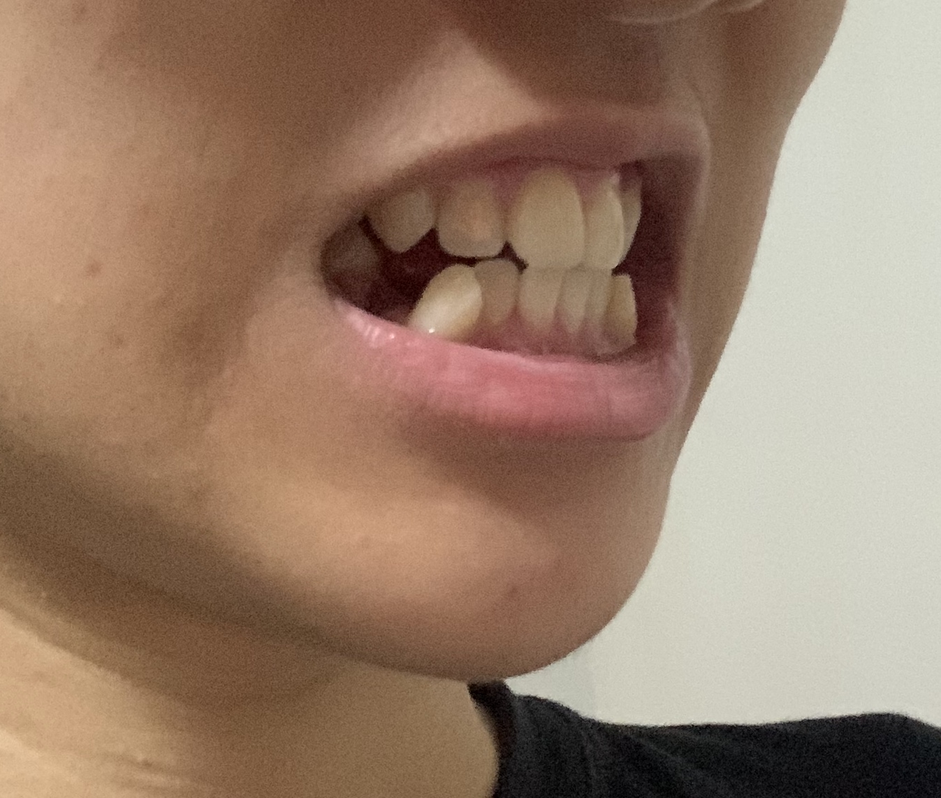 Carmen Braces Tooth Extraction