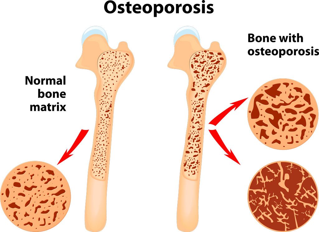 ACV for Weight Loss With advantages and disadvantages May cause bone loss