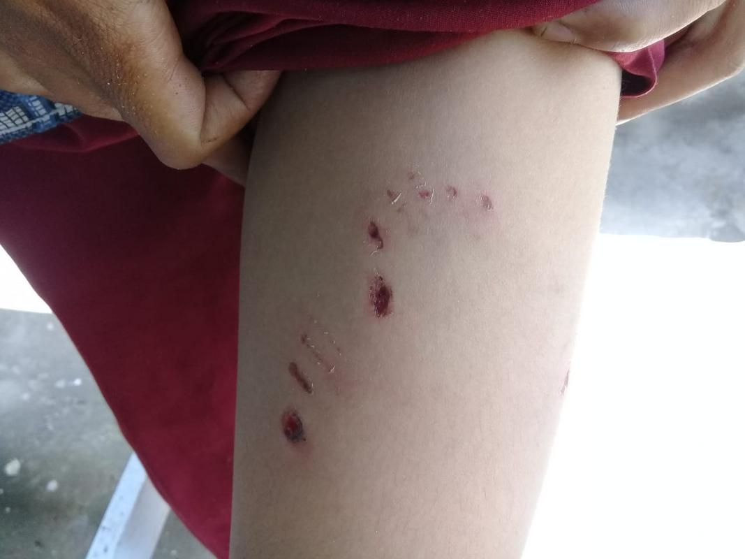 Seorang Anak Di Bumi Ayu Jadi Korban Gigitan Aniing Tetangganya