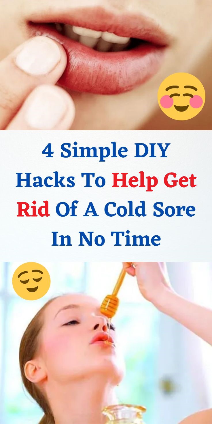 4 Simple DIY Hacks To Help Get Rid Of A Cold Sore In No Time Healthy