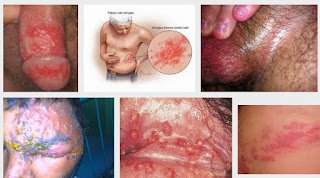 Pengobatan penyakit herpes secara tradisional