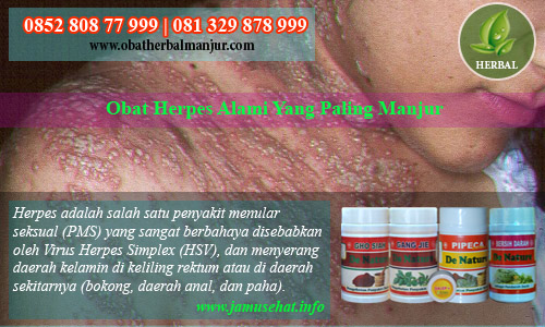 obat herpes kronis