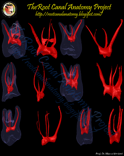 The Root Canal Anatomy Project: Four-Rooted Maxillary Second Molars