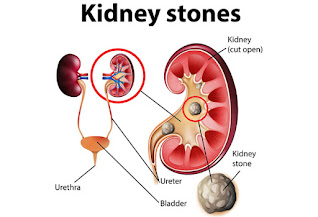 Get relief from kidney stone with these home remedies Get relief from kidney stone with these home remedies