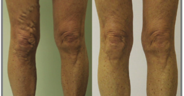 The Hidden Vein Problem Affecting Millions Dont Ignore These Symptoms - vqqnj6e