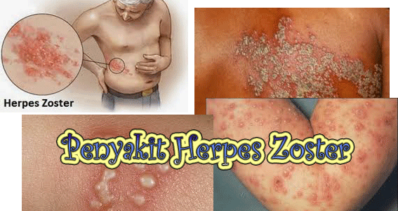 Penyakit herpes Zoster
