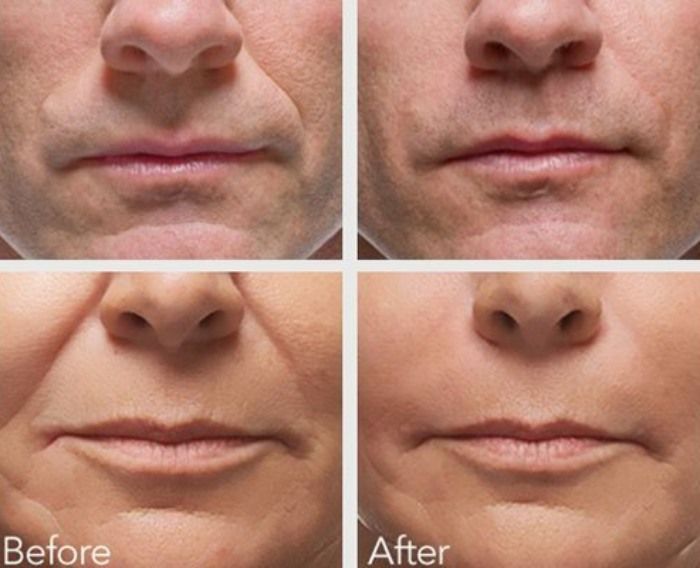 Selston Cosmetic Clinic Ease Nasolabial Grooves With Dermal Filler