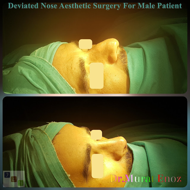 Deviated and Thick Skinned Nose Aesthetic Surgery For Men