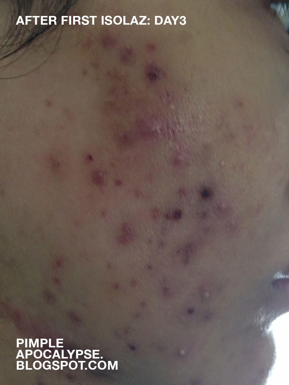 pimple apocalypse My experience with Isolaz and Laser Genesis (still