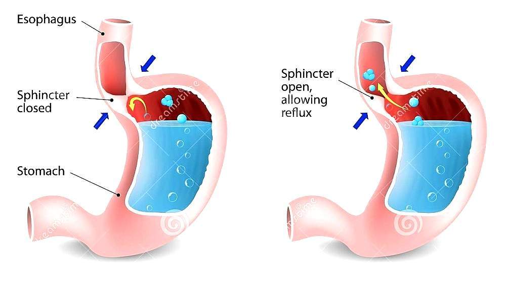 Gastroesophageal reflux disease