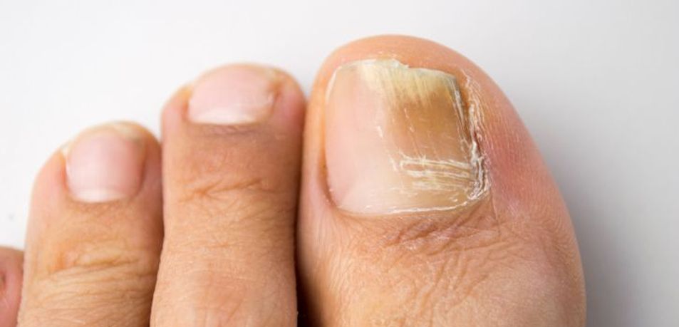 gombaellenes származó köröm gomba gyógyszerek kezelés nail gombák lábra