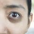 Tipo de Ojeras y Cómo Tratarlas Naturalmente