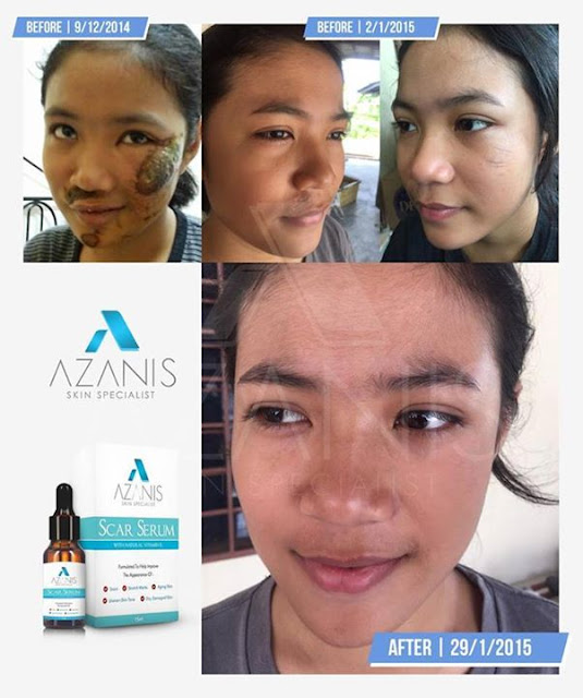 Testimoni Azanis Scar Serum - Parut Besar Di Muka