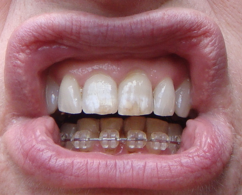 Braces at 56: More reproximation and power chain elastics!