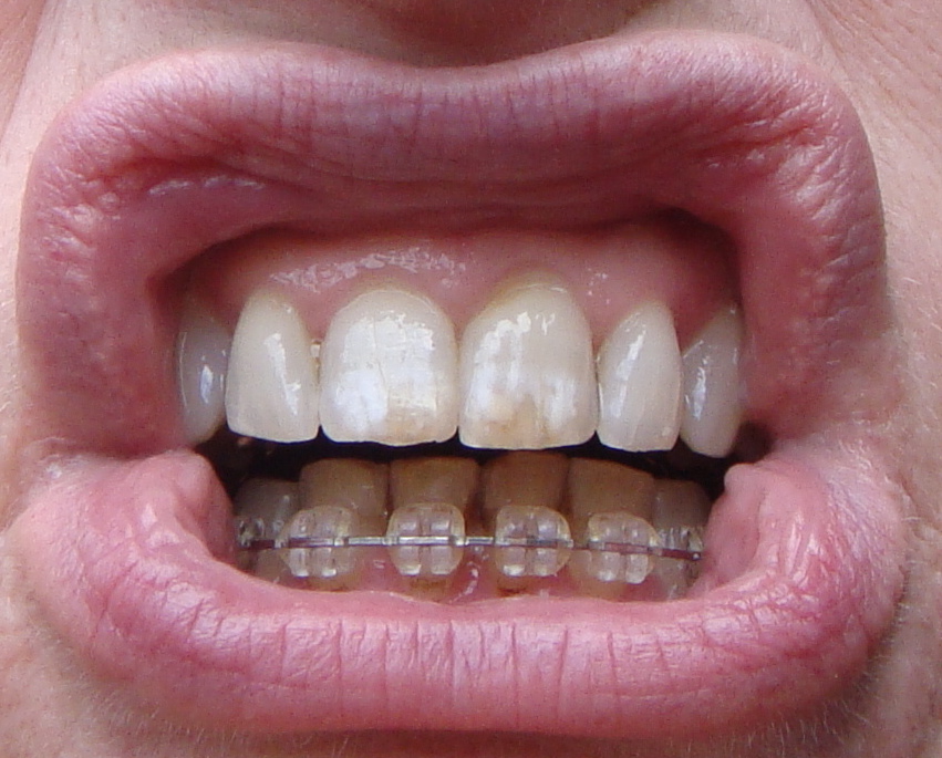 Braces at 56 More reproximation and power chain elastics!