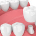4 kinh nghiệm bọc răng sứ cho người cần