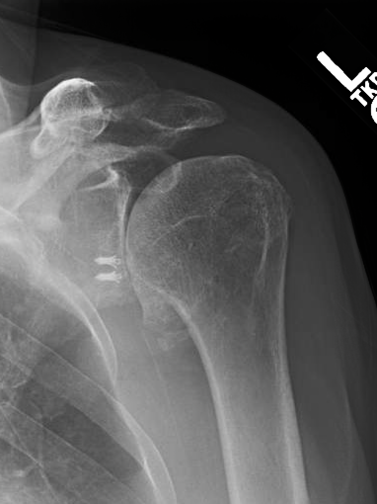 Shoulder Arthritis / Rotator Cuff Tears causes of shoulder pain