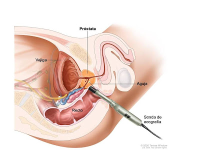 Biopsia de prostata