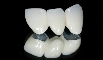Nguyên nhân bọc răng sứ bị đen chân răng