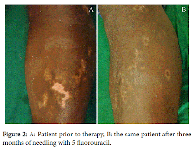 Tratamiento Exitoso del Vitiligo por Punción con 5 Fluorouracilo Topical-Caso 2