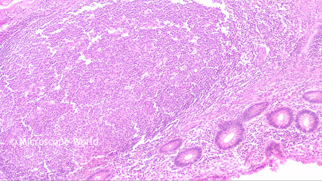 Appendicitis captured under the Fein Optic RB30 lab microscope using the HD microscopy camera at 100x.