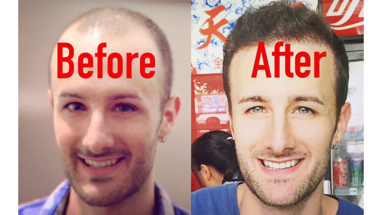 denverhairrestoration Advantages Hair restoration laboratories shampoo