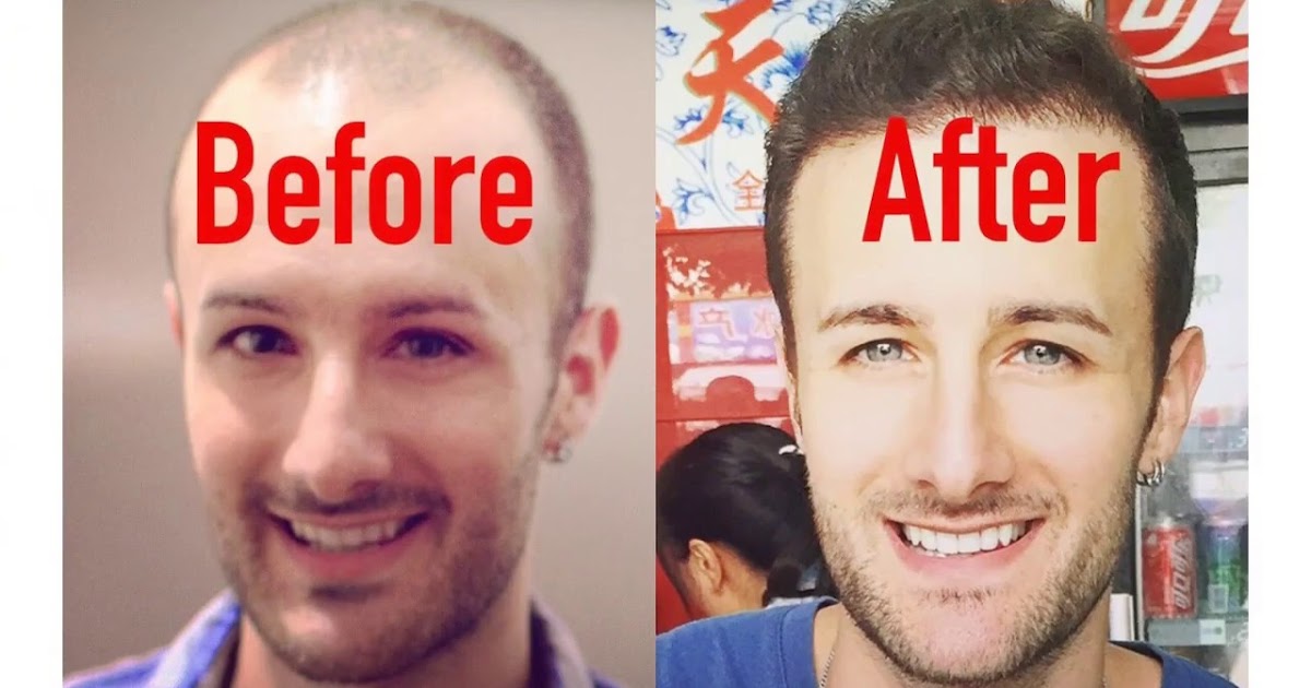 denverhairrestoration Advantages Hair restoration laboratories shampoo