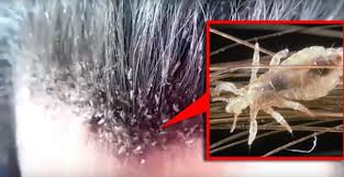 Ternyata Dari bahayanya Kutu di Rambut, Ada Juga Fakta-fakta Uniknya. Inilah 5 Fakta Unik dari Kutu Ternyata Dari bahayanya Kutu di Rambut, Ada Juga Fakta-fakta Uniknya. Inilah 5 Fakta Unik dari Kutu