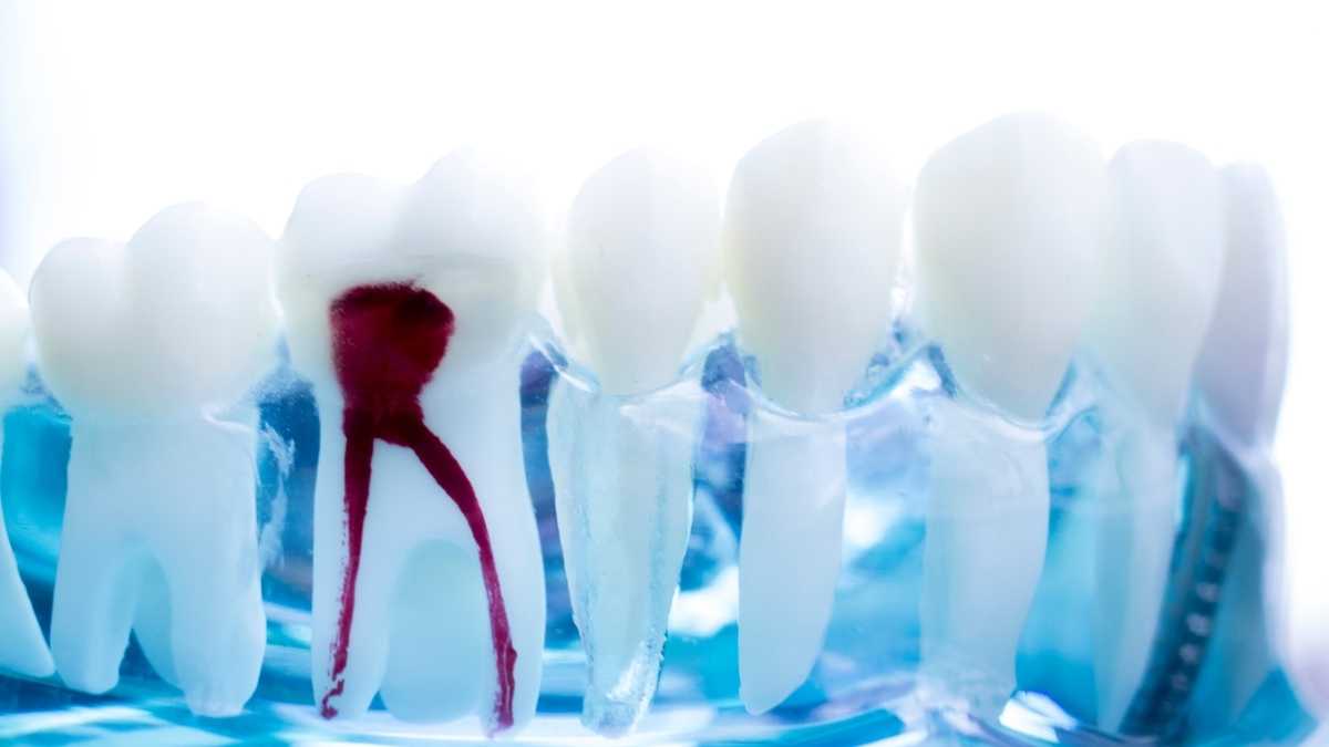 Why Re Root Canal Is A Must for Many Patients