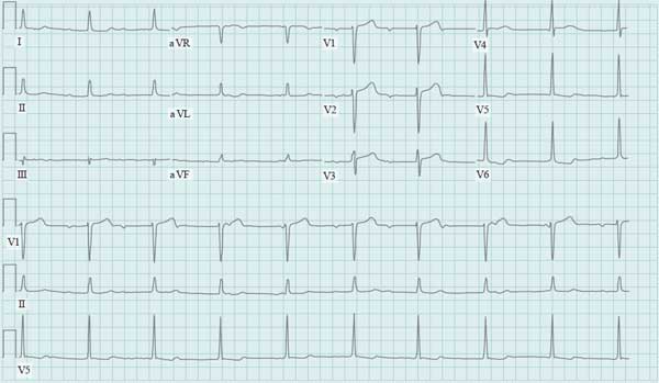 ECG-for-bradycardia