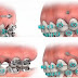 Khắc phục tình trạng răng mọc lệch hàm với niềng răng