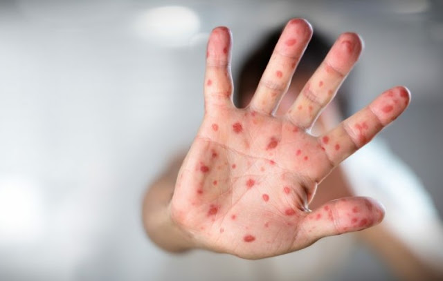 Ministério da Saúde confirma 1.226 casos de sarampo no Brasil