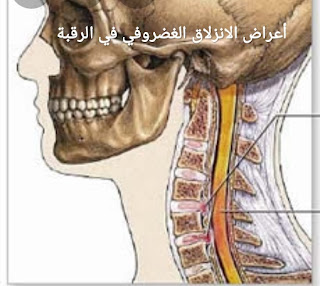 أعراض الانزلاق الغضروفي في الرقبة