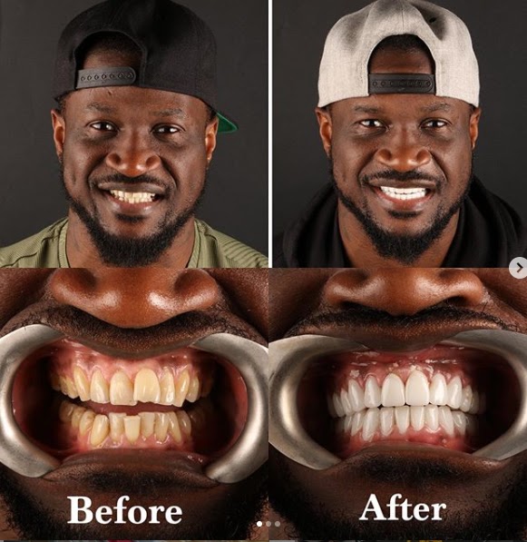 Peter Okoye apologizes to ladies he has kissed after fixing his teeth and undergoing teeth whitening