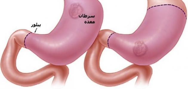 اعراض سرطان المعدة عند الإنسان اعراض سرطان المعدة عند الإنسان