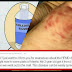 This Mother Shares How Her Daughter Got Hand, Foot And Mouth Disease (HFMD). Read And Be Aware.