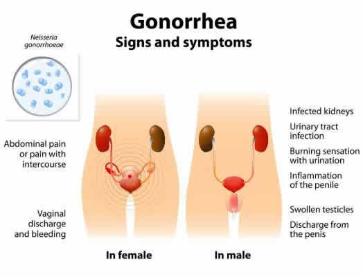 Gonorrhea signs and symptoms