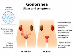Gonorrhea signs and symptoms