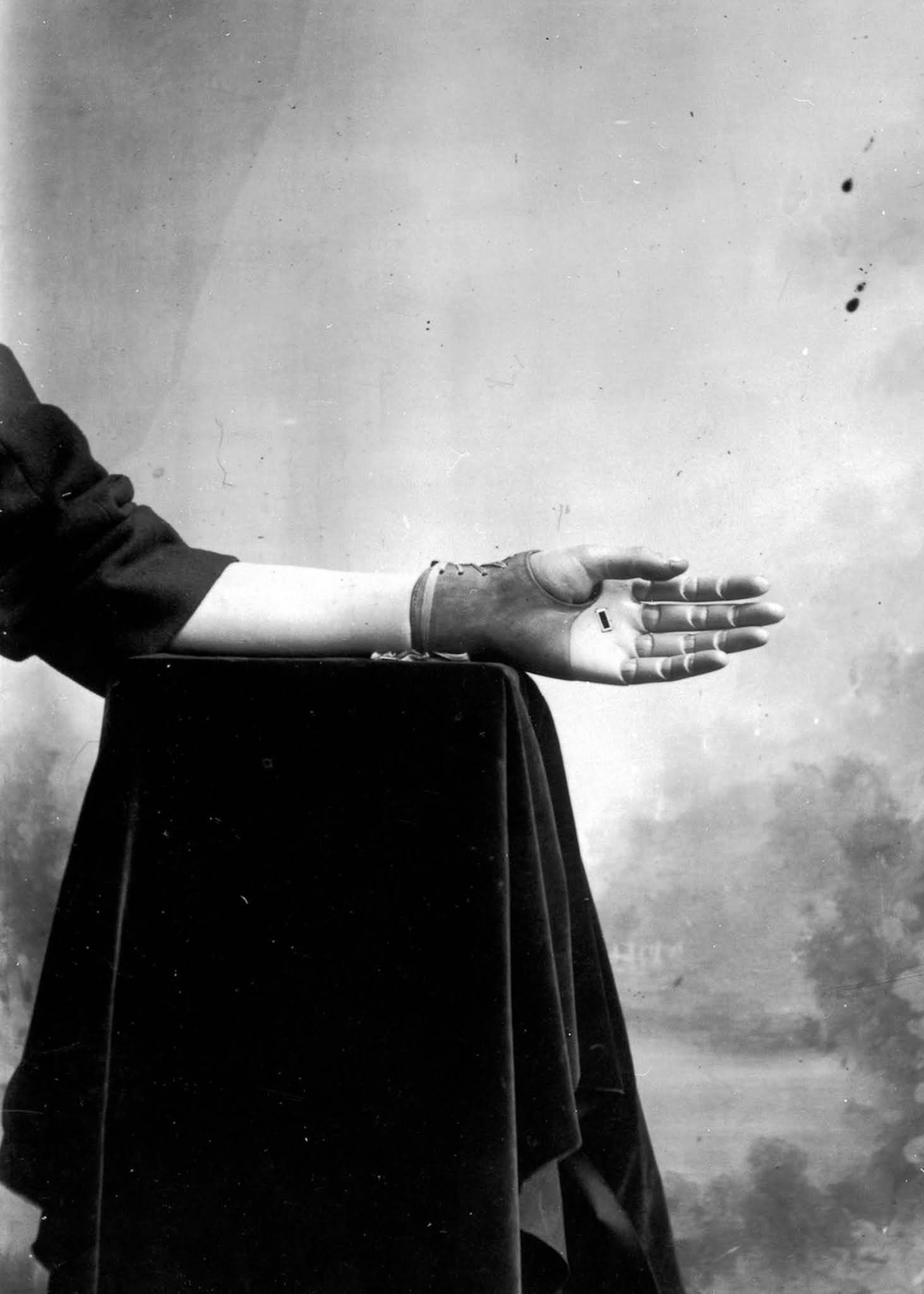 The extraordinary early prostheses made by James Gillingham  1900 - 12