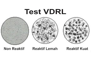 Obat Untuk Penyakit Vdrl Tpha Wanita Positif Sifilis