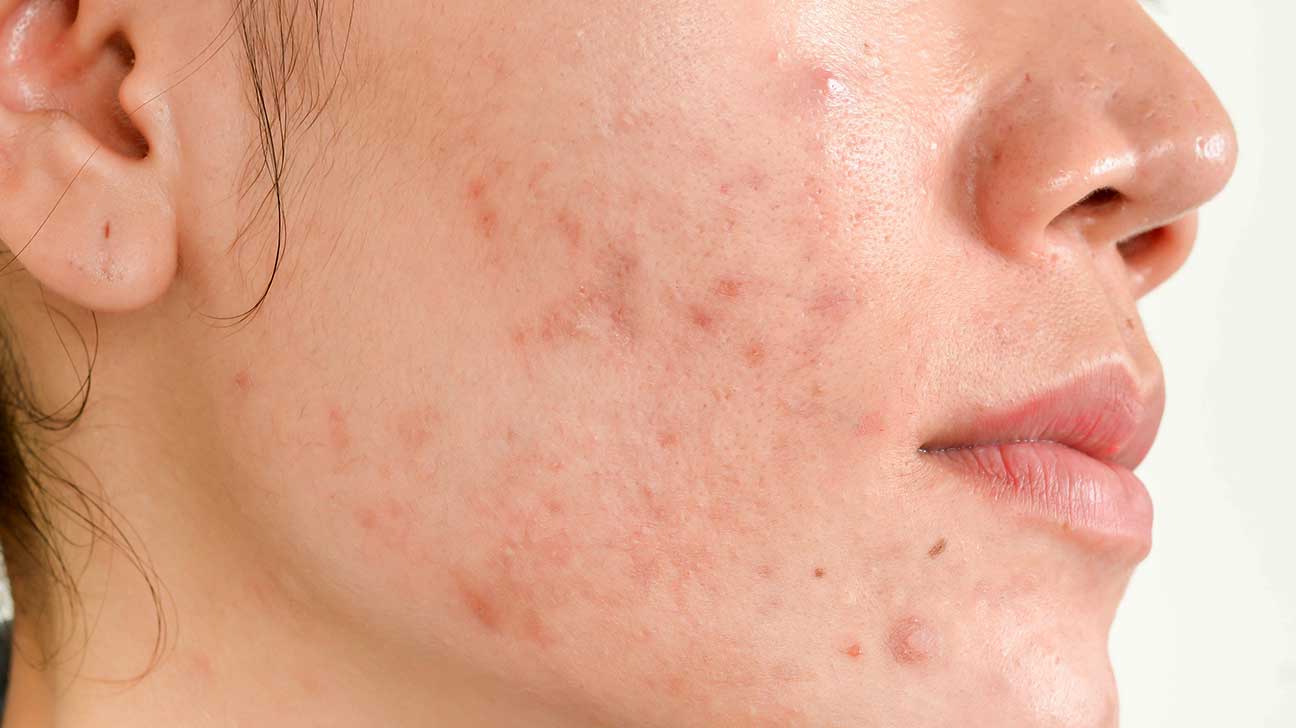 Simple Methods To Clear Up Acne Scars