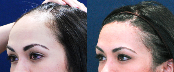 Best Hair Transplantation Dubai Different Types Of Hair Loss In