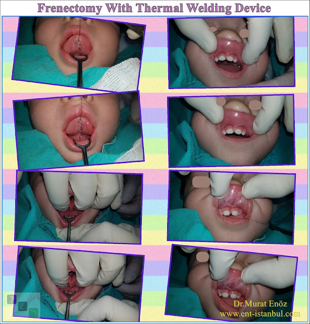 lip tie surgery, tongue tie operation, frenectomy
