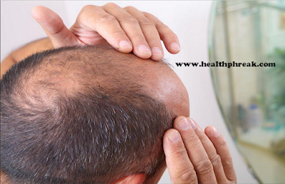 hair loss, baldness, 3 Things to Consider About Hair Transplant Surgery, Hair Transplant Surgery