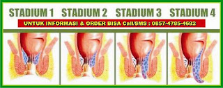 obat wasir tanpa operasi stadium 3 obat wasir tanpa operasi stadium 4
