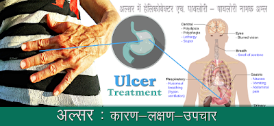 पेट अल्सर , Ulcer treatment in hindi पेट अल्सर Ulcer treatment in hindi, pet alsar ka ilaj, pet ke ulcer kya hota hai, पेट अल्सर उपचार , pet ulcer ka upchar, Ulcer Ke Lakshan, अल्सर के लक्षण, अल्सर ठीक करने के अचूक घरेलू तरीके, pet ke ulcer ke gharelu upay, अलसर का उपचार